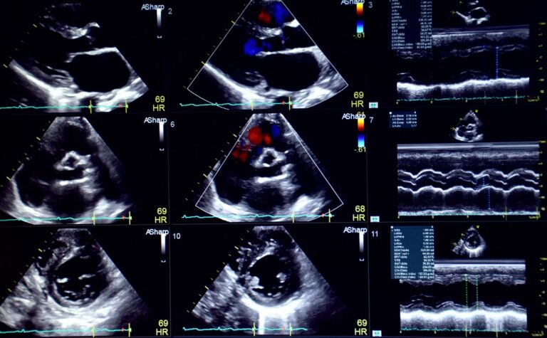 What is an Echocardiogram?